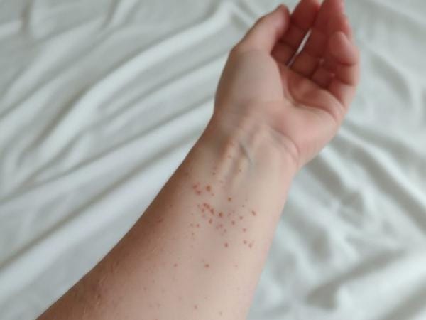 Secretaría de Salud refuerza vigilancia epidemiológica por segundo caso de sarampión en Puebla